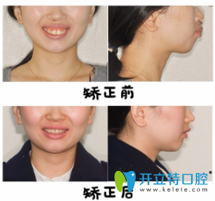 偉聯(lián)口腔黃淑微隱適美牙齒矯正前后效果對比圖