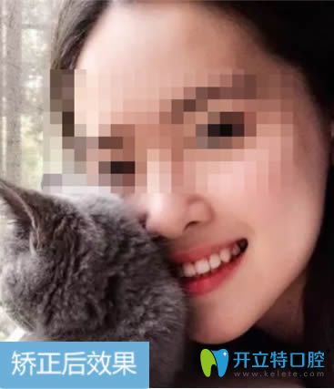 28歲的我在深圳拜爾佩戴自鎖金屬托槽12個月的效果