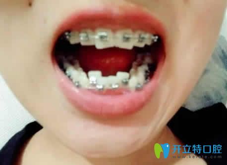 我在廣州偉聯(lián)口腔做牙齒矯正后個月的照片