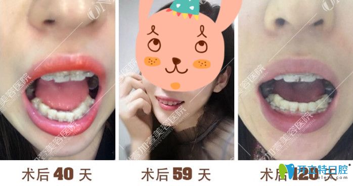 廣州壹加壹矯正40-120天牙齒變化過(guò)程圖