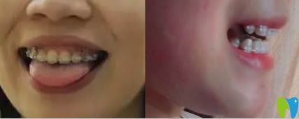 廣州壹加壹口腔陶瓷托槽矯正術中照