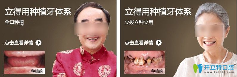 天津中諾立得用種植牙案例效果