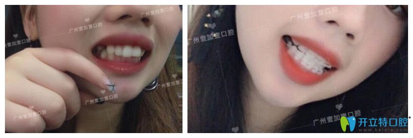 廣州壹加壹齙牙、牙齒擁擠不齊矯正案例效果前后對(duì)比照片