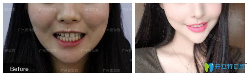 牙縫大采用美加瓷貼面修復(fù)對(duì)比圖