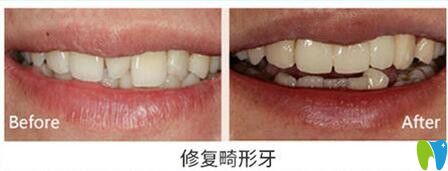 天津美奧口腔修復(fù)畸形牙齒對(duì)比圖