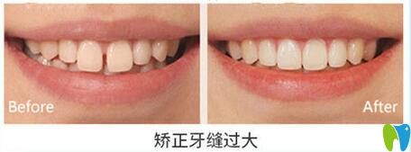 天津美奧口腔矯正牙縫過(guò)大效果圖