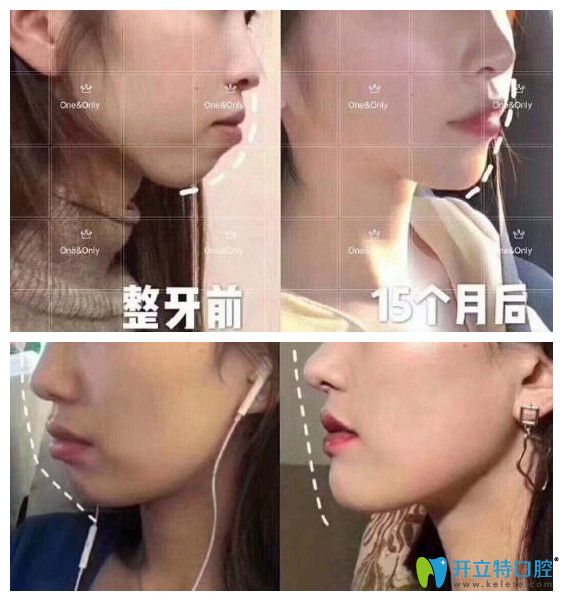 廣州壹加壹矯正牙齒好嗎？小姐姐在壹加正畸打卡記錄公開