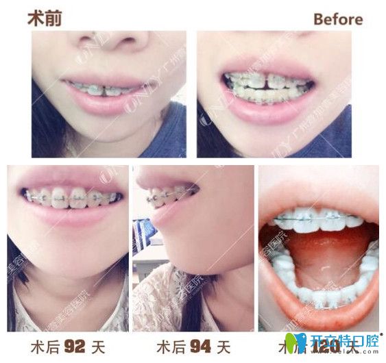 壹加壹齙牙，門牙縫隙矯正過程中牙齒變化圖