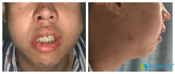正頜手術(shù)當(dāng)天