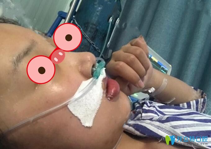 廣州廣大口腔正頜手術(shù)后即刻照片