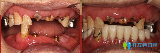 廣州廣大口腔半口牙種植案例圖