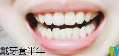 我在深圳諾德口腔做牙齒矯正6個(gè)月