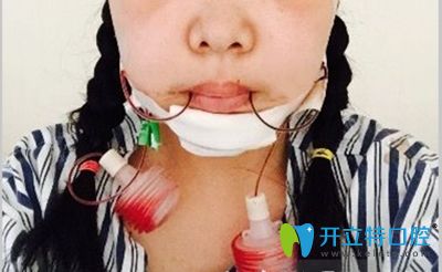 我做正頜手術(shù)的當(dāng)天照
