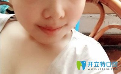 廣大口腔何錦泉醫(yī)生給做完正頜手術(shù)4個月效果