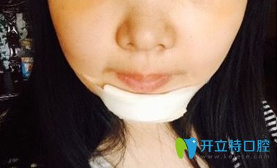 做正頜手術(shù)半月后效果圖