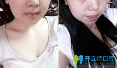 廣州廣大口腔三思后,在廣州廣大口腔讓何錦泉醫(yī)生做了正頜聯(lián)合正畸手術(shù)