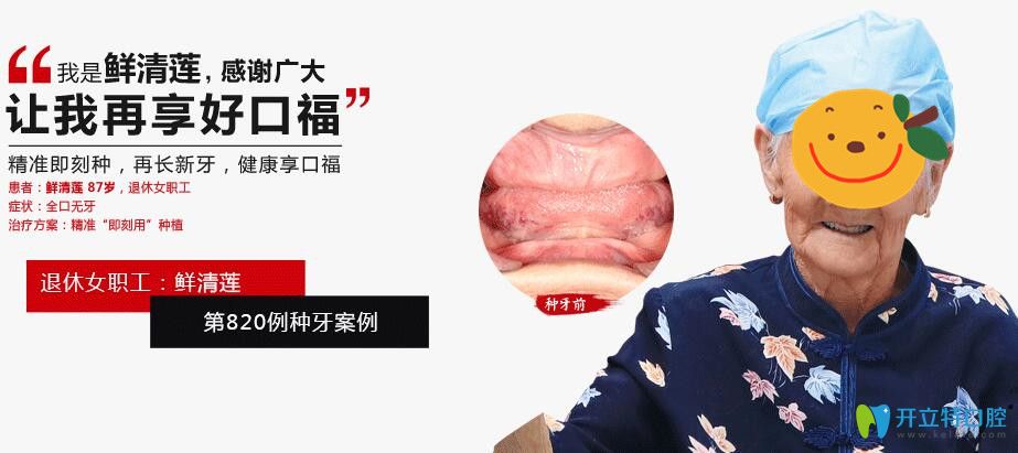廣大口腔為87歲拉破人做精準(zhǔn)即可種植牙案例效果圖