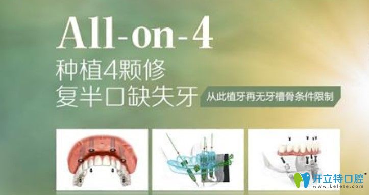 深圳龍華區(qū)拜爾口腔的allon4種植牙技術
