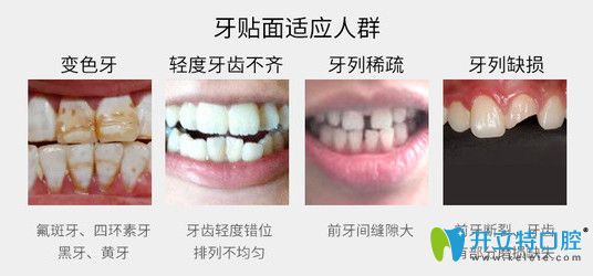 牙齒貼面適應人群