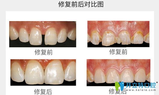 牙齒貼面修復前后對比圖