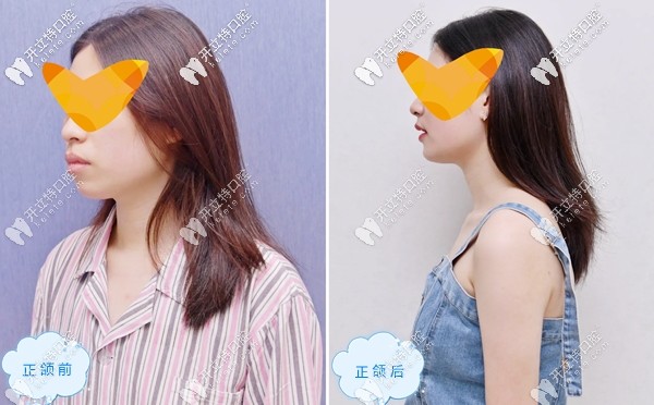 吳小姐在廣大口腔做正頜的前后效果圖