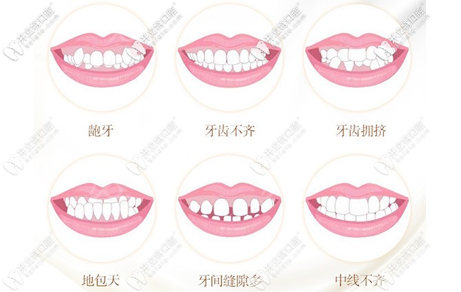 牙齒矯正的適應(yīng)癥狀