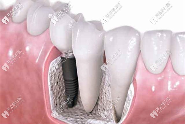 廣州廣大口腔的韓國登騰和奧齒泰價(jià)格